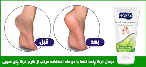 کرم ترک پا , کرم ترک پا هوبی , درمان ترک پا , رفع ترک پا , کرم درمان ترک پا