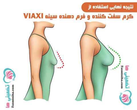 فرمدهی سینه و لیفتینگ سینه فرمدهی سینه و لیفتینگ سینه